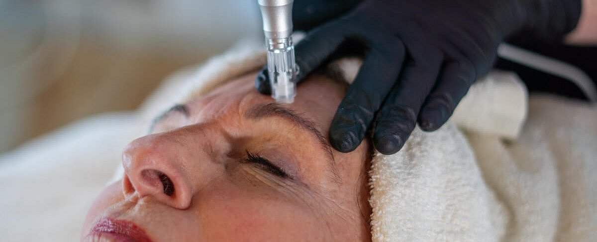 Frau erhält Micro-Needling Behandlung